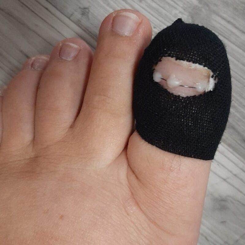 tape zarostleho nehtu
